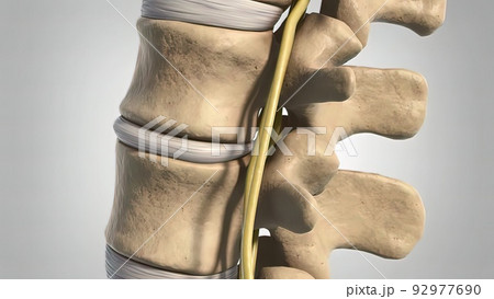 Disc shift in the spinal cordのイラスト素材 [92977690] - PIXTA