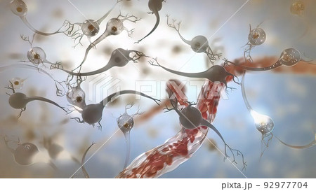 Death of neurons 3d medical Death of neurons 3d medical 92977704