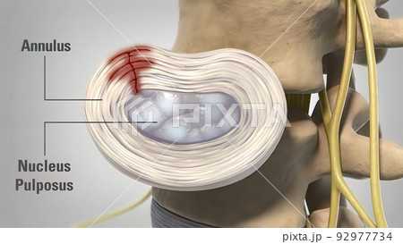 Degenerative dics disease 3d medical 92977734