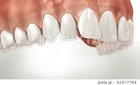 Invisalign braces or invisible retainer make bite correction. Medically accurate 92977768