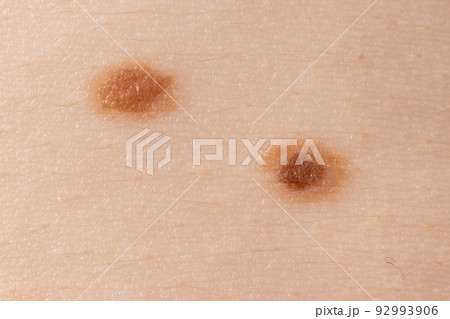 Two Mole birthmark nevus macro photo on human skin. Close up. 92993906