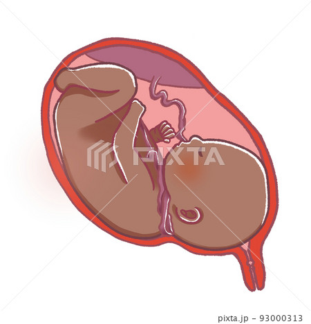 臍帯巻絡　首にへその緒が巻きついている赤ちゃん 93000313