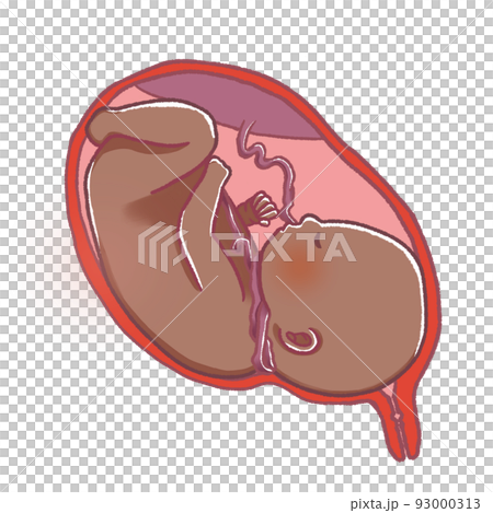 Umbilical cord winding A baby with an umbilical cord wrapped around its neck 93000313