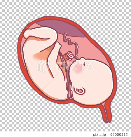 臍帶纏繞 臍帶繞在脖子上的嬰兒 93000315