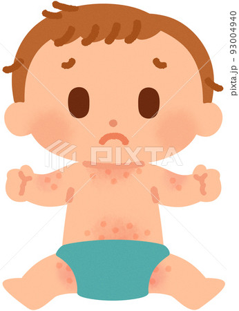 あせもが出来ている赤ちゃん 正面 のイラスト素材