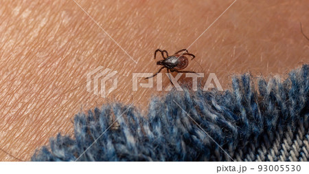 Infected female deer tick on hairy human skin. Ixodes ricinus. Parasitic mite. Acarus. Dangerous biting insect on background of epidermis detail. Disgusting carrier of infections. Tick-borne diseases 93005530