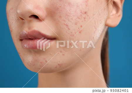Teenage girl with acne problem on blue background, closeup 93082401