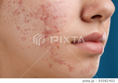 Teenage girl with acne problem on blue background, closeup 93082402