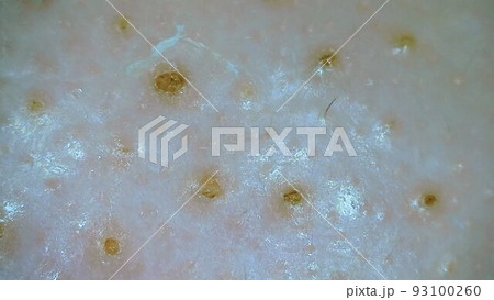 角栓　小鼻 93100260