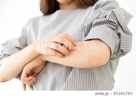 腕をかくアトピーの若い女性 93101767