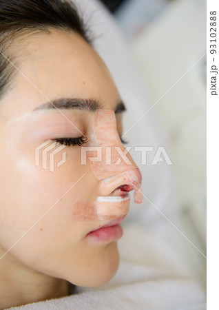 Side view of woman with bandage on her nose after rhinoplasty 93102888