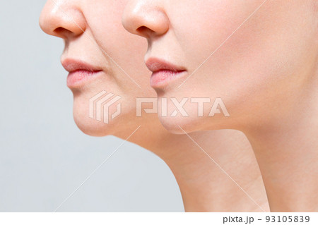 A close portrait of an aged woman before and after the facelift procedure. The result of facial rejuvenation and wrinkle smoothing in a cosmetology clinic. 93105839