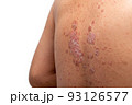 Psoriasis is that back on white background. 93126577