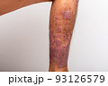 Psoriasis is that knee on white background. 93126579