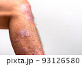 Psoriasis is that knee on white background. 93126580