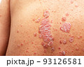 Psoriasis is that back on white background. 93126581