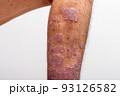 Psoriasis is that knee on white background. 93126582