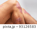 Psoriasis is that knee on white background. 93126583