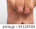 Psoriasis is that elbow on white background. 93126584