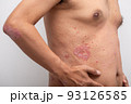 Psoriasis is the abdomen on white background. 93126585
