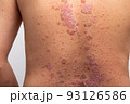 Psoriasis is that back on white background. 93126586