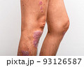Psoriasis is that knee on white background. 93126587
