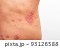 Psoriasis is that back on white background. 93126588