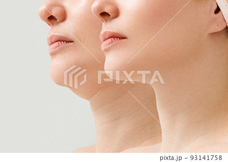 A close portrait of an aged woman before and after the facelift procedure. The result of facial rejuvenation and wrinkle smoothing in a cosmetology clinic. A close portrait of an aged woman before and after the facelift procedure. The result of facial rejuvenation and wrinkle smoothing in a cosmetology clinic. 93141758