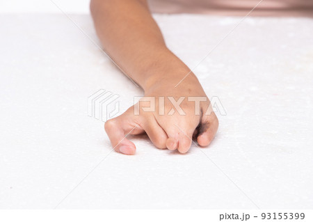 Disabled person hand without fingers since childhood brith, no thumb nail on white background isolated. Woman hands handicap show gesture look disability with arm and surgery wound to split finger Disabled person hand without fingers since childhood brith, no thumb nail on white background isolated. Woman hands handicap show gesture look disability with arm and surgery wound to split finger 93155399