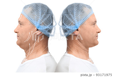 Mature man before and after plastic surgery operation on white background. Double chin problem Mature man before and after plastic surgery operation on white background. Double chin problem 93171975