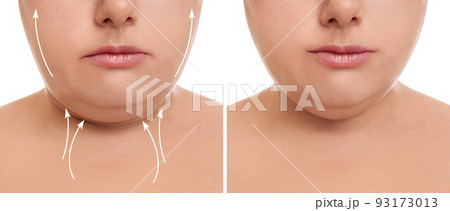 Woman before and after plastic surgery operation on white background, closeup. Double chin problem Woman before and after plastic surgery operation on white background, closeup. Double chin problem 93173013