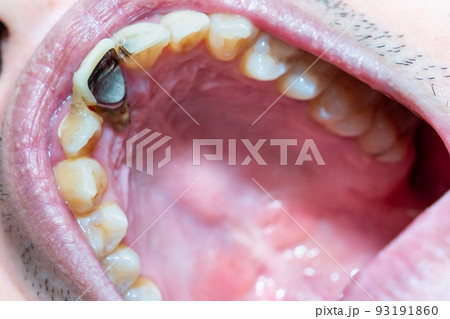 歯根虫歯の写真。根本が露出した歯の写真。酷い虫歯。 93191860
