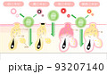 ニキビ 93207140