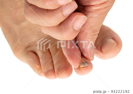 怪我で剥がれた足の爪 怪我で剥がれた足の爪 93222192