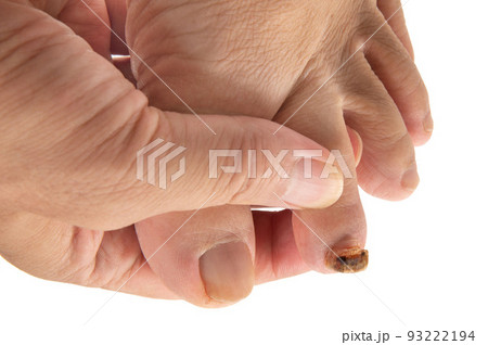 怪我で剥がれた足の爪 怪我で剥がれた足の爪 93222194