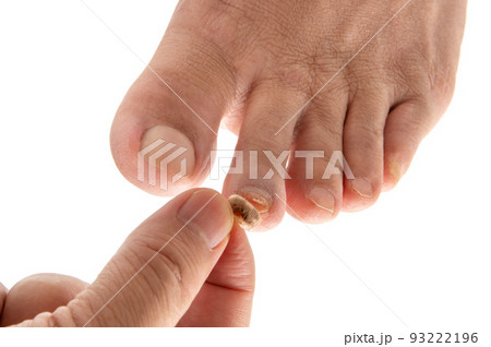 怪我で剥がれた足の爪 怪我で剥がれた足の爪 93222196