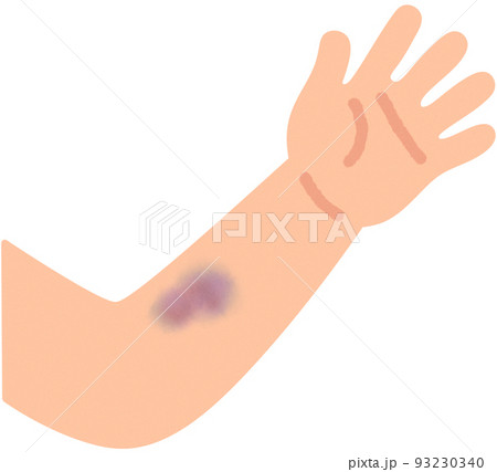 青あざがある腕 93230340