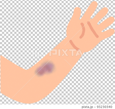 青あざがある腕 93230340