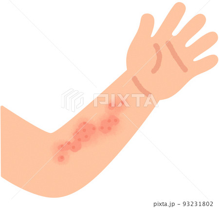 蕁麻疹ができた腕 93231802