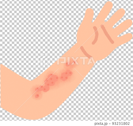 arm with hives 93231802