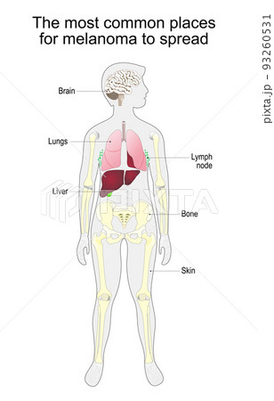 metastasis of skin cancer. malignant melanoma. 93260531