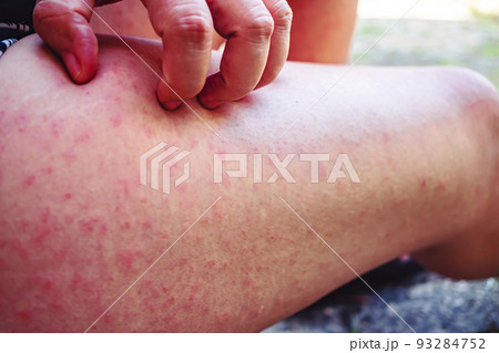 Itching of the wound on the thigh, A young woman scratching her legs with one hand due to itching, A woman scratching her thigh because of a rash. 93284752