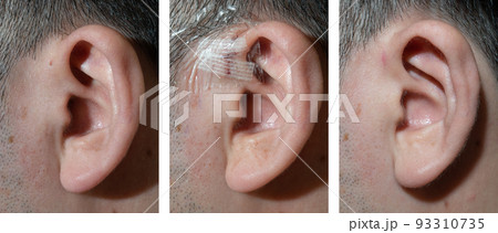 耳瘻孔（左から術前、手術直後、術後半年。30代男性） 93310735