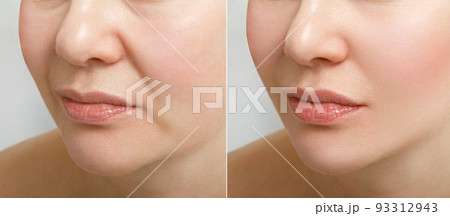 Portrait of an aged woman before and after the facelift procedure. The result of facial rejuvenation and wrinkle smoothing in a cosmetology clinic. 93312943