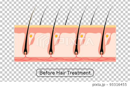 Image of hair removal, before and after hair treatment 93316455