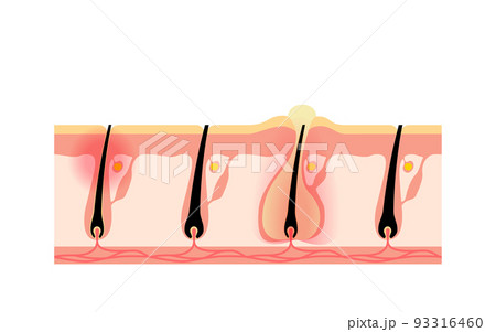 脱毛のイメージ、肌トラブル、毛を自分で剃って肌が荒れた状態 93316460