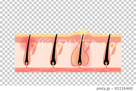 脱毛のイメージ、肌トラブル、毛を自分で剃って肌が荒れた状態 93316460