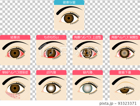 眼にまつわる病気の図解した素材 93323371