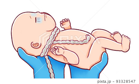 出産　へその緒が巻きついている赤ちゃんを取り上げているイラスト 93328547