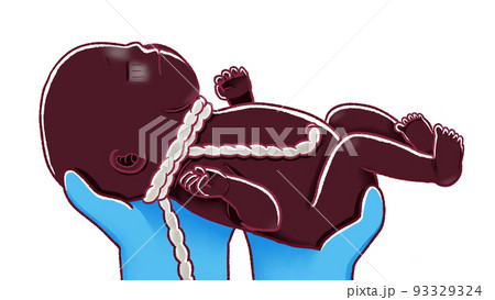 出産の瞬間のイラスト へその緒が巻きついている赤ちゃん 出産の瞬間のイラスト へその緒が巻きついている赤ちゃん 93329324